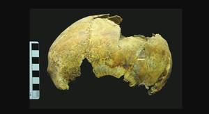 发现了一个有5000年历史的人的头骨，他做过古代的脑部手术